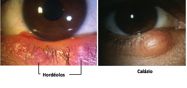 Hordeolo e calazio